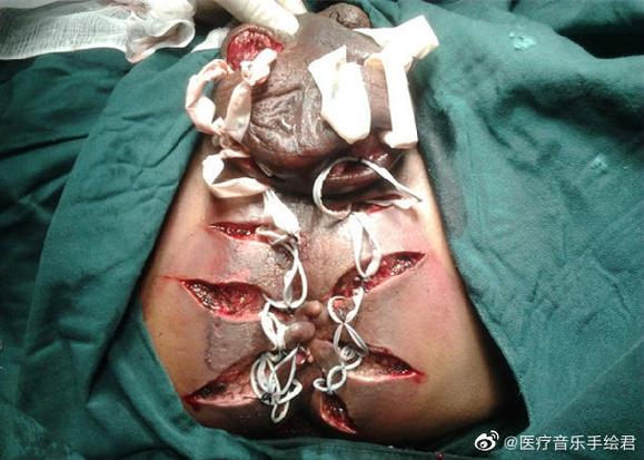 玻尿酸丰臀的危害_玻尿酸丰臀怎么样自然吗_